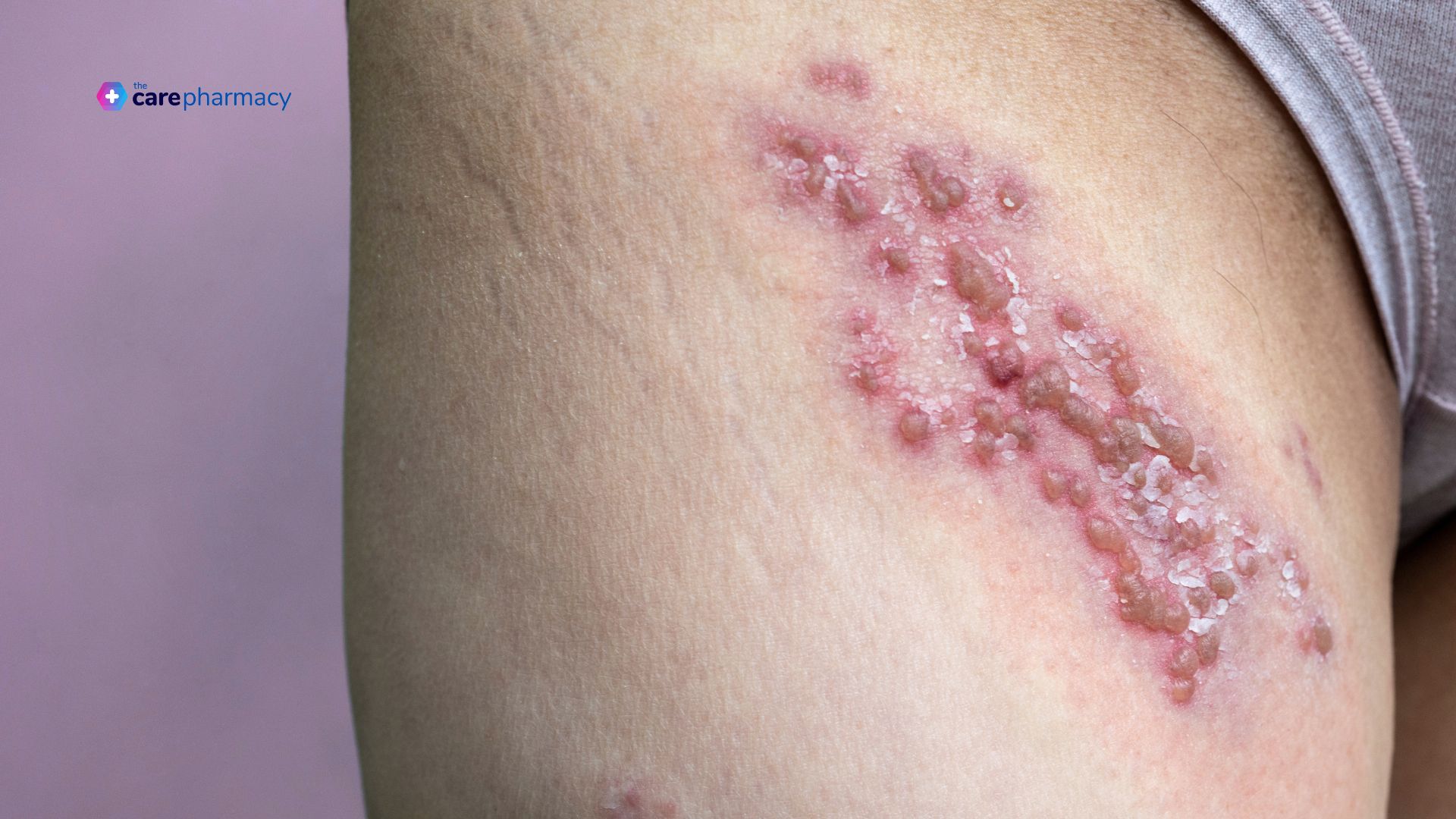 Shingles rash on patient's back